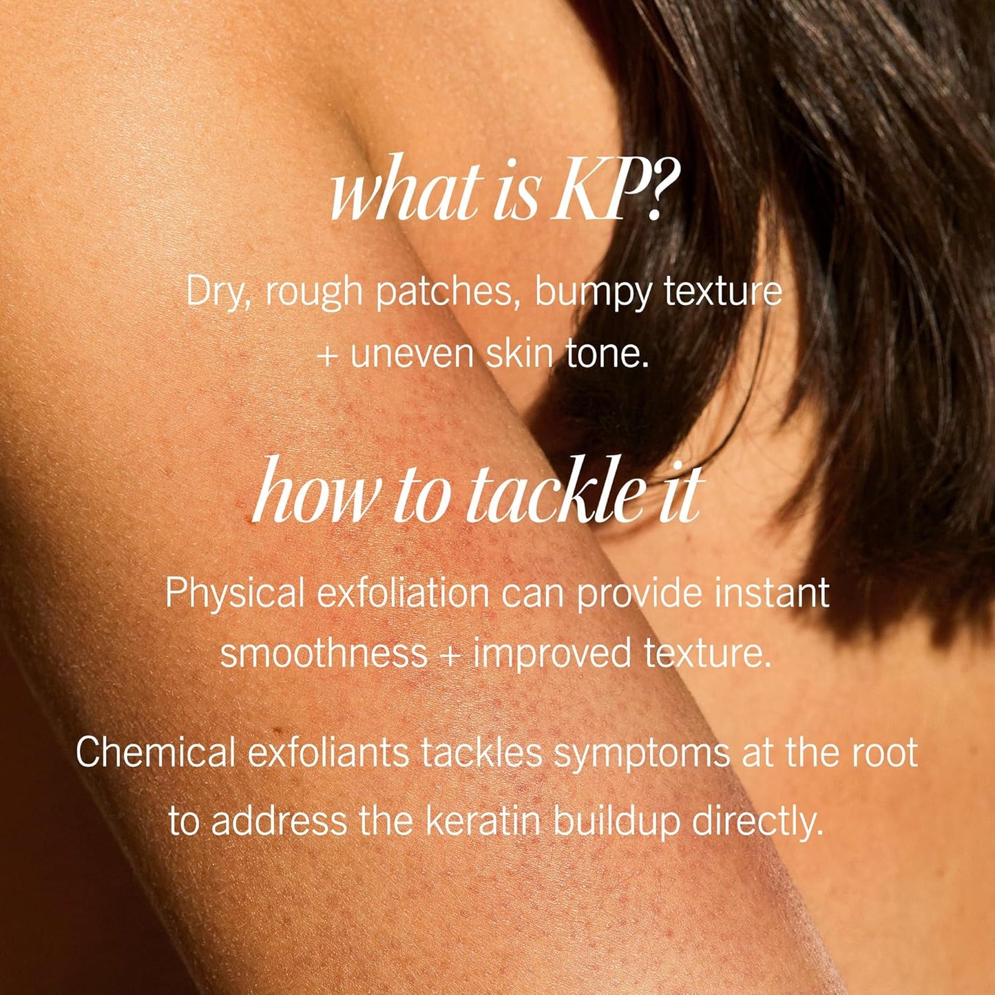 First Aid Beauty - KP Bump Eraser Body Scrub with 10% AHA, Keratosis Pilaris Skin Exfoliater with Glycolic and Lactic acids, Helps Reduce Chicken Skin Bumps, Safe for Sensitive Skin, 4 oz