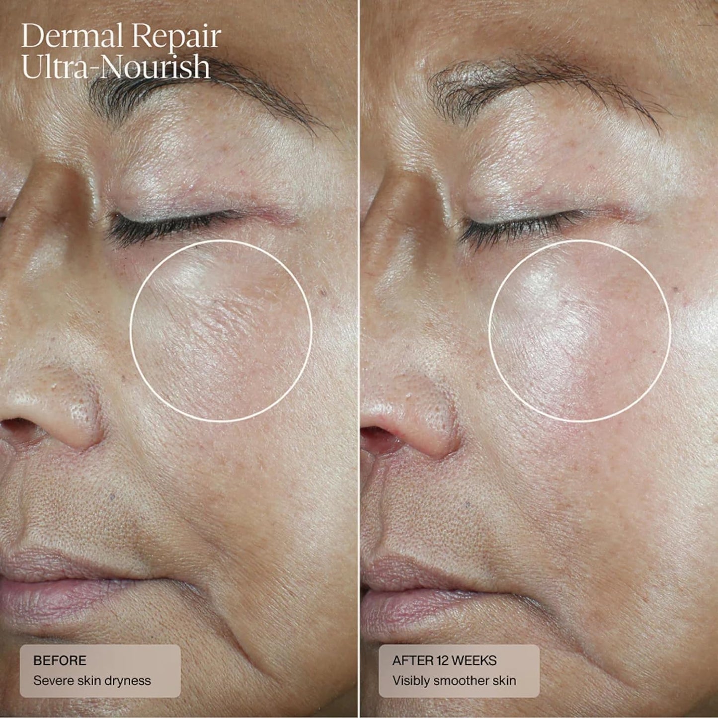 Senté Dermal Repair Ultra-Nourish - Rosacea Treatment For Dry, Sensitive Skin | Repairs, Replenishes & Reduces Skin Redness - 1.7 Fl Oz